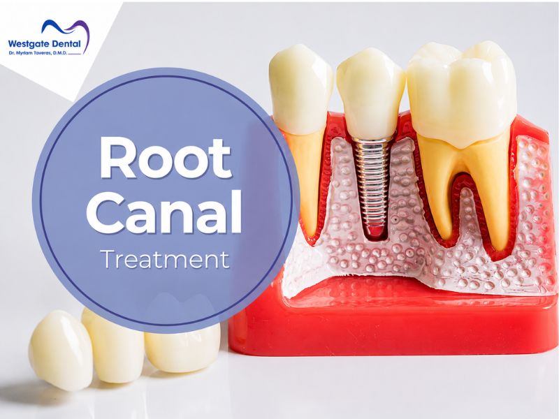 Root Canal